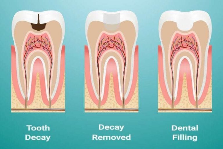 How Long Does it Take to Fill a Cavity