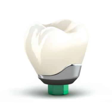 Advancements In Implant Dentistry