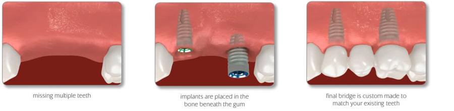 Dental Implants in Buckhead