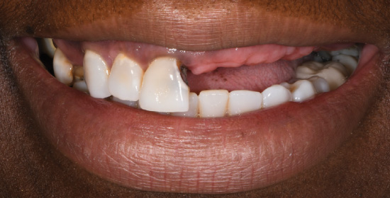 Dental implants Atlanta