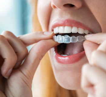 Invisalign