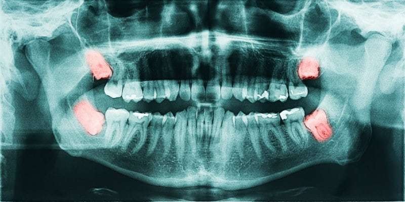 Xray of wisdom teeth