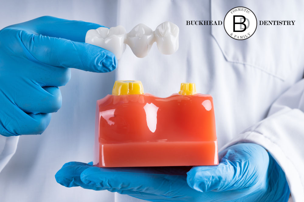Dental Bridges