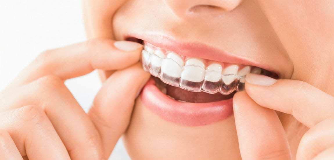 invisalign Dental Atlanta