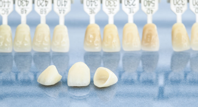 dental veneers